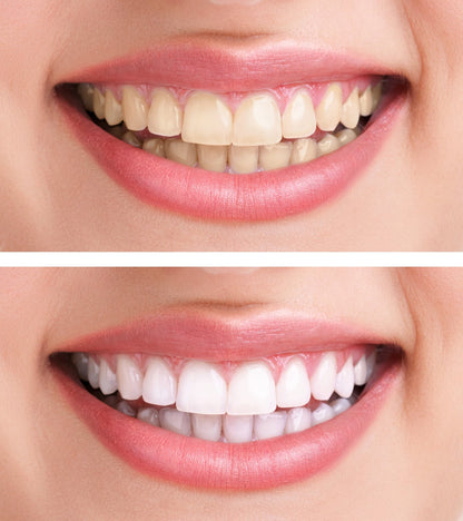 Hi Smile Teeth Whitening Serum V34